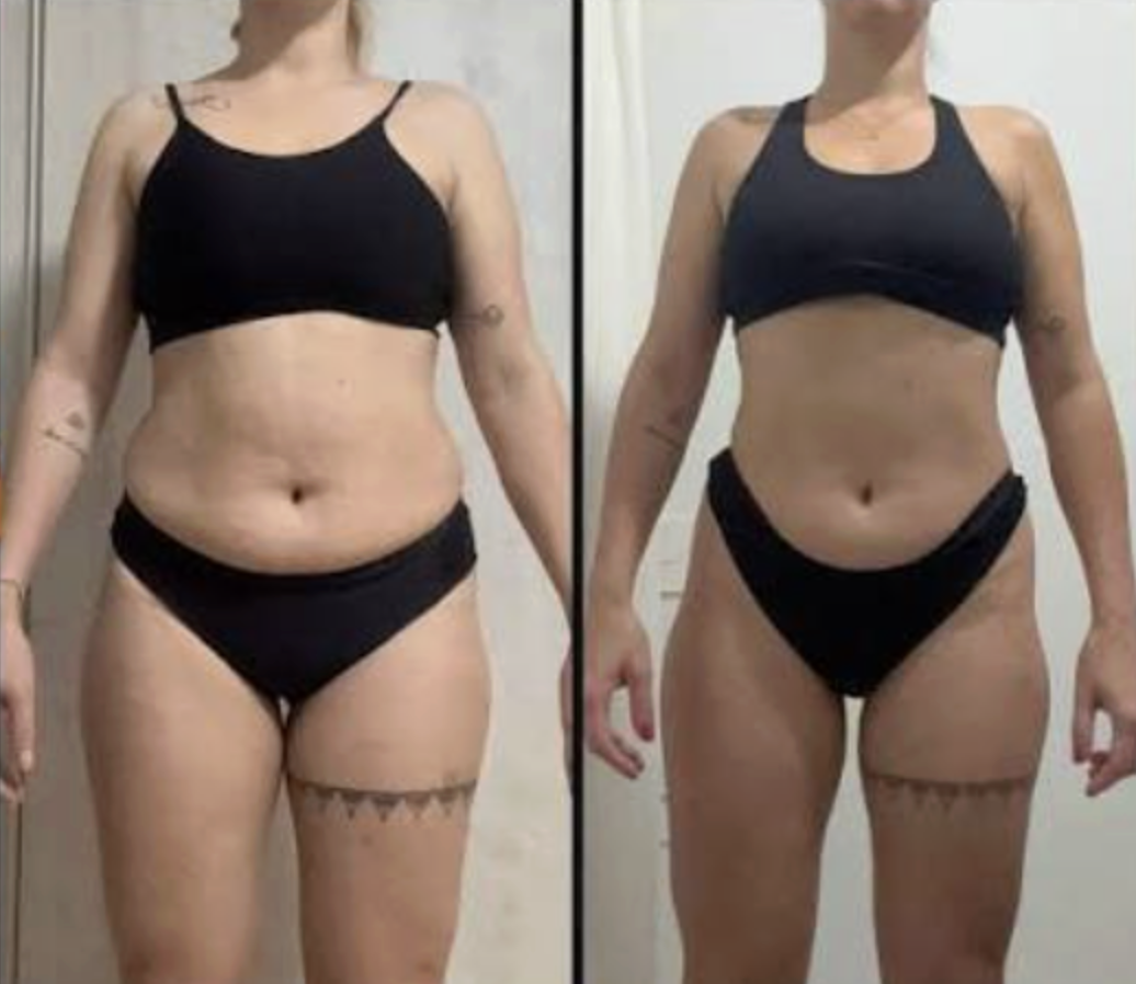 Antes e depois de Juliana R., 37 anos — Barriga mais seca e cintura definida